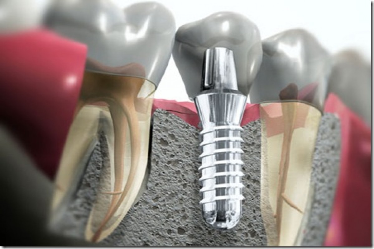 Implantes Dentários